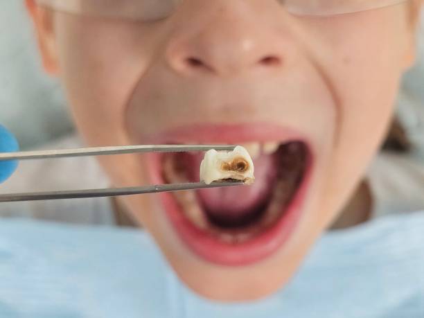Best Emergency Tooth Extraction in Owosso, MI