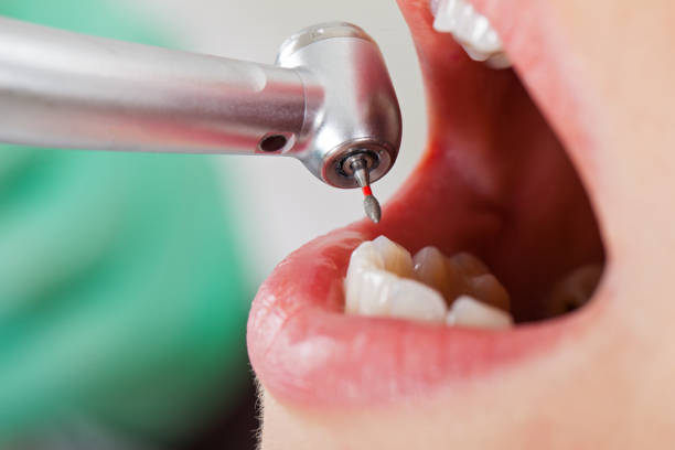 Best Emergency Tooth Extraction in Owosso, MI